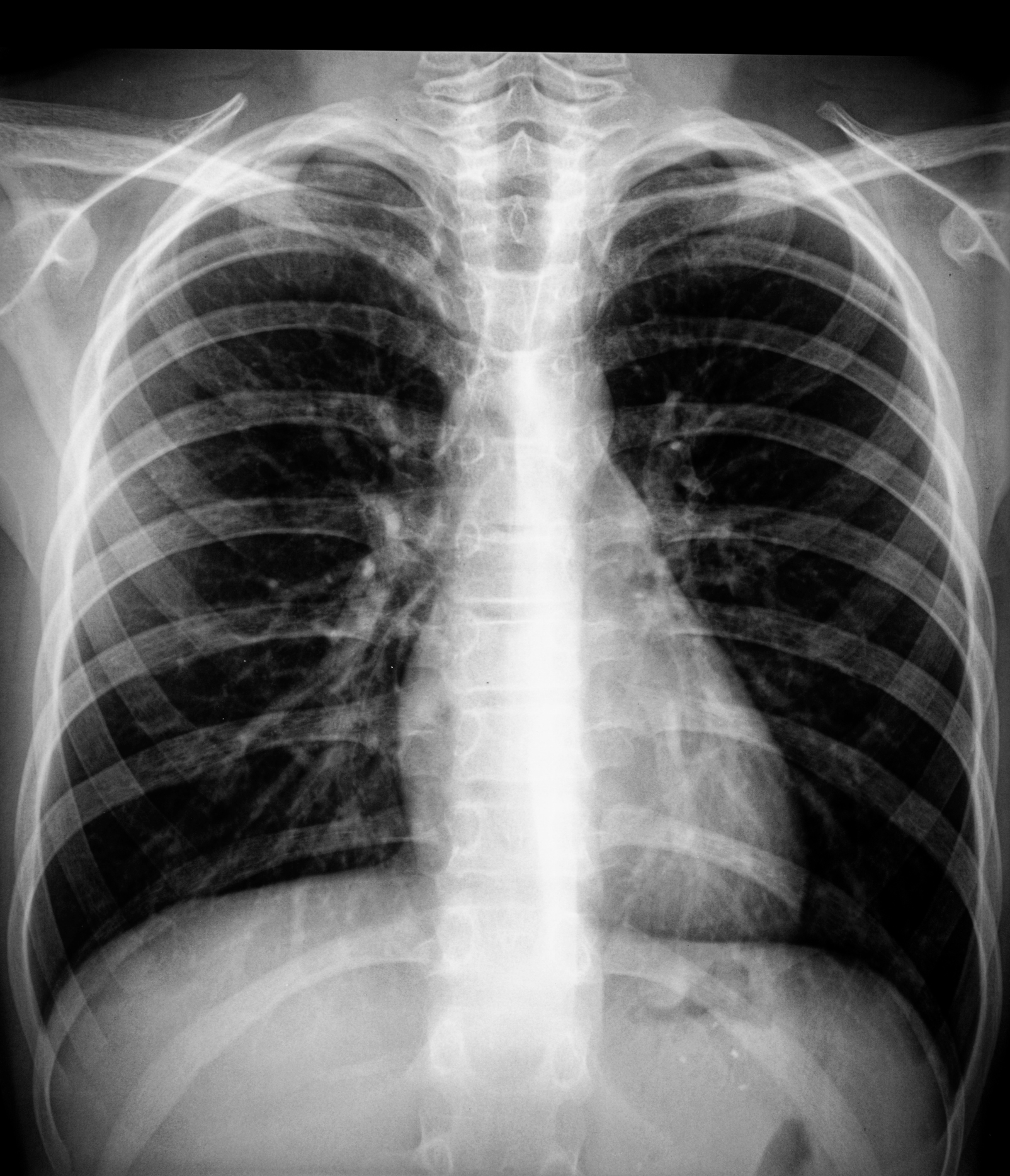 X-ray image showing a person's chest, focusing on the ribs, lungs, and spine