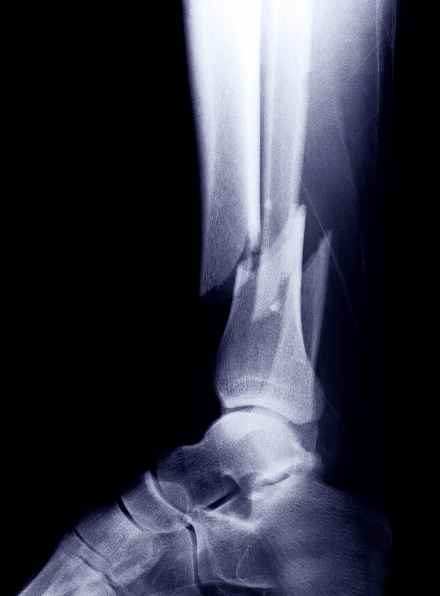 An X-ray image showing a fractured lower leg bone