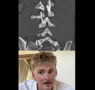 Forrest Frank shows proof of broken back, rapid healing: 'Did we see a