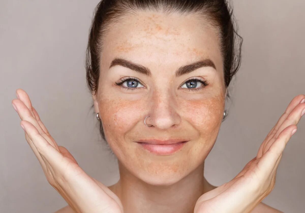 Qué tipos de manchas en la piel existen y a qué edad aparecen