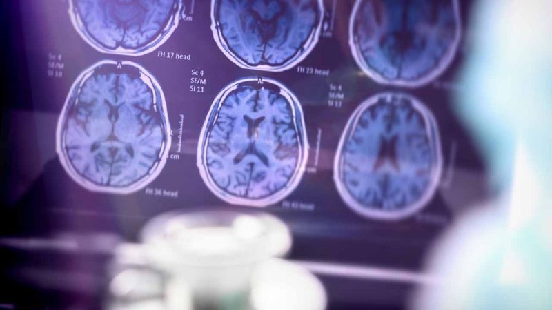 How a blood test can determine dementia risk - Study Blood Test Could Detect Dementia Early