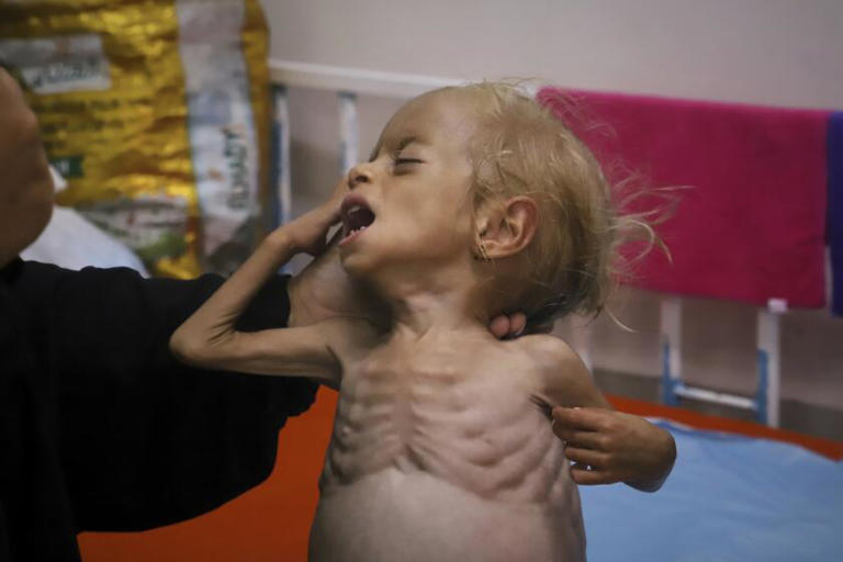 Islam Qudeih muestra a Shamm, su hija de dos años, gravemente desnutrida, ante los periodistas en el hospital Nasser, en Jan Yunis, en el sur de la Franja de Gaza, el sábado 9 de agosto de 2025. Los médicos afirman que la niña podría tener un trastorno genético que afecta el desarrollo de músculos y huesos, pero no hay forma de realizar exámenes para detectarlo en Gaza. El martes 12 de agosto, su familia obtuvo autorización para trasladarla a un hospital de Italia. ((Mariam Dagga / Associated Press))