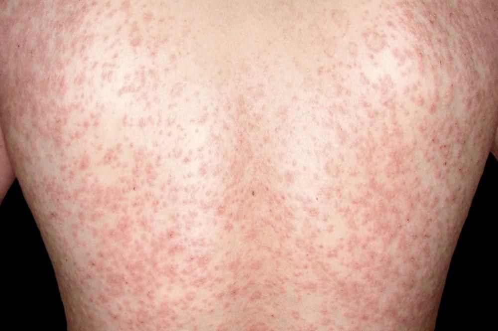 7 Jenis Penyakit Kulit Akibat Virus
