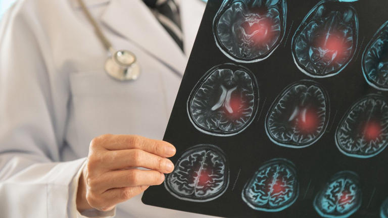 Silent Stroke สู่ Stroke นาทีชีวิต ภัยเงียบสมองขาดเลือด ที่ป้องกันได้ถ้ารู้ทัน