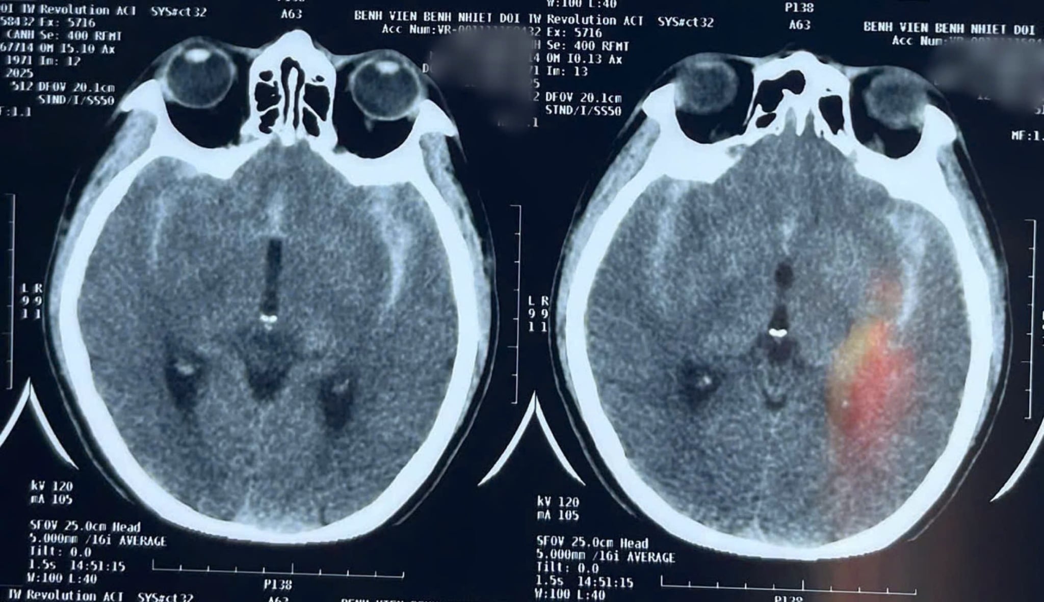 Túi phình động mạch não vỡ khiến người đàn ông suýt chết