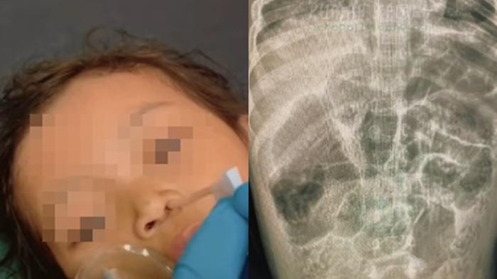 Jawaban Menko Pratikno Soal Bocah Tewas Cacingan di Sukabumi Viral