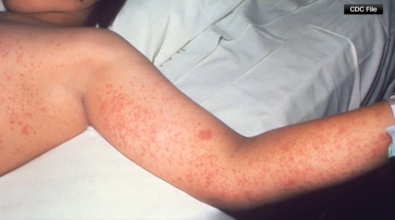 Virginia Department of Health investigates potential measles exposure ...