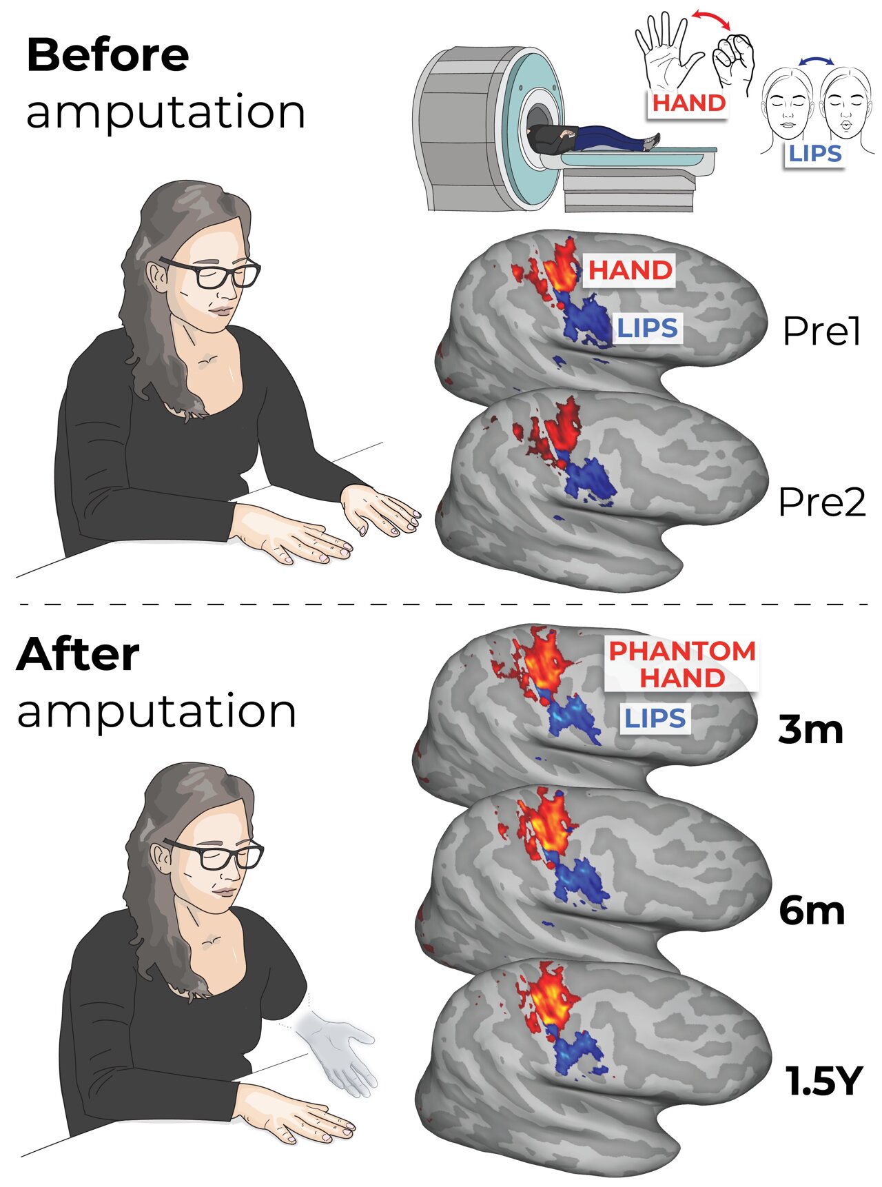 Gone, But Not Forgotten: Brain's Body Map Remains After Amputation