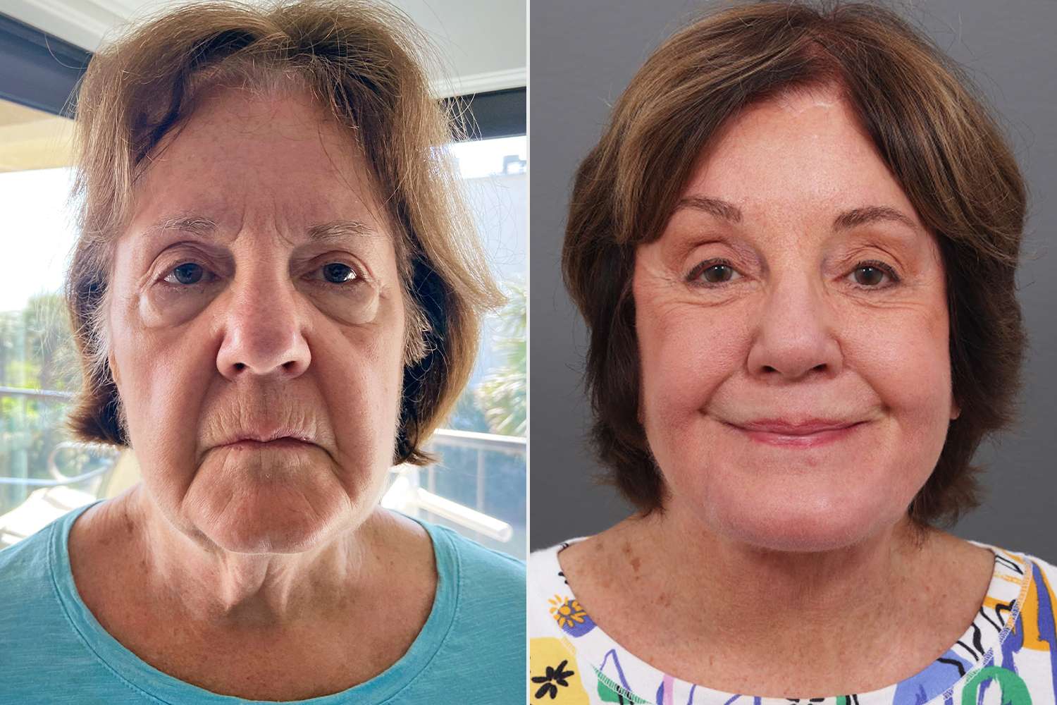 Woman, 78, Goes Viral for Her Transformative Facelift Results, Even