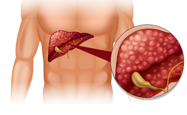 How To Reverse Fatty Liver Naturally: Follow These Diet And Lifestyle Tips