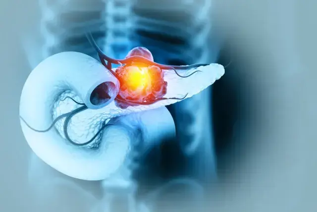 Nueva vacuna experimental muestra eficacia contra cáncer de páncreas y colorrectal en ensayos clínicos