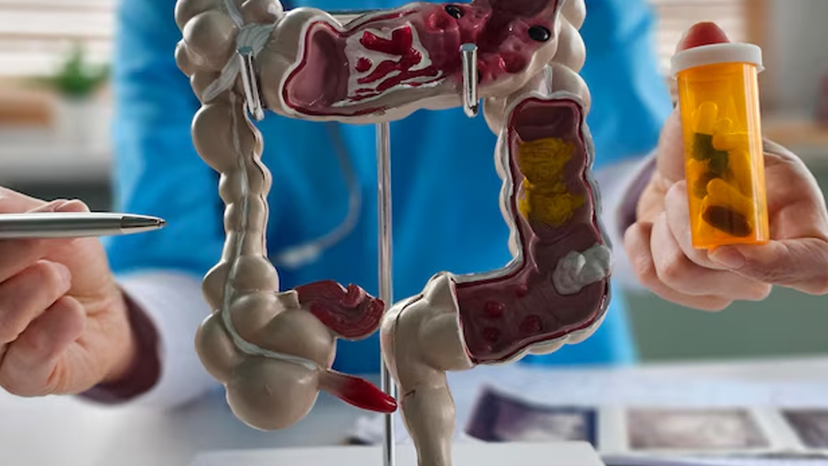 Colon Cancer Vs. Irritable Bowel Syndrome (IBS) How To Tell The Difference