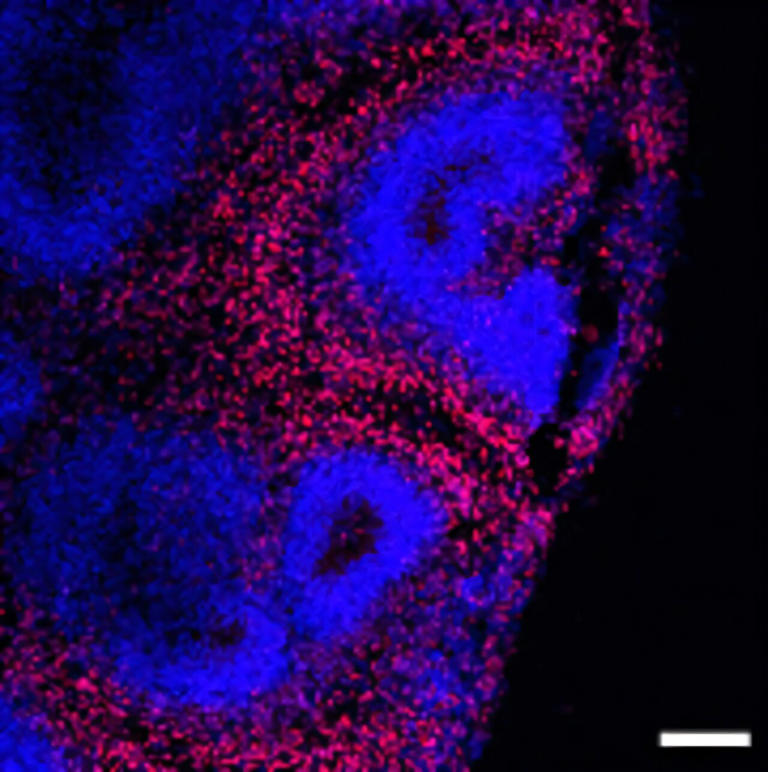 Alzheimer's disease pathology and potential treatment