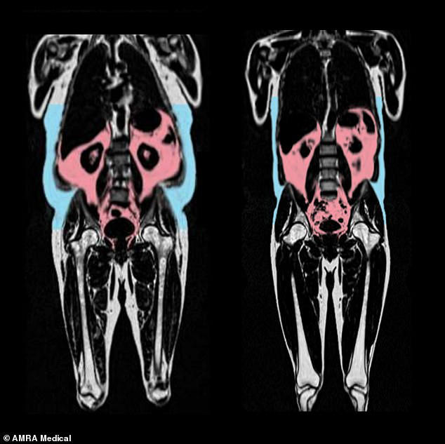 Two MRI scans showing a person (left) with more visceral fat (in red) and subcutaeous fat (in blue)
