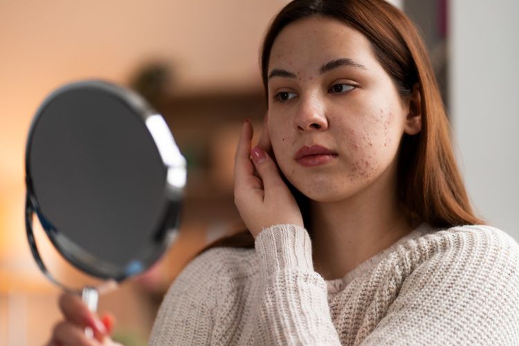 Khawatir Jerawat Muncul Akibat Sunscreen? Ini 7 Tips Pemilihan Sunscreen untuk Kulit Berjerawat