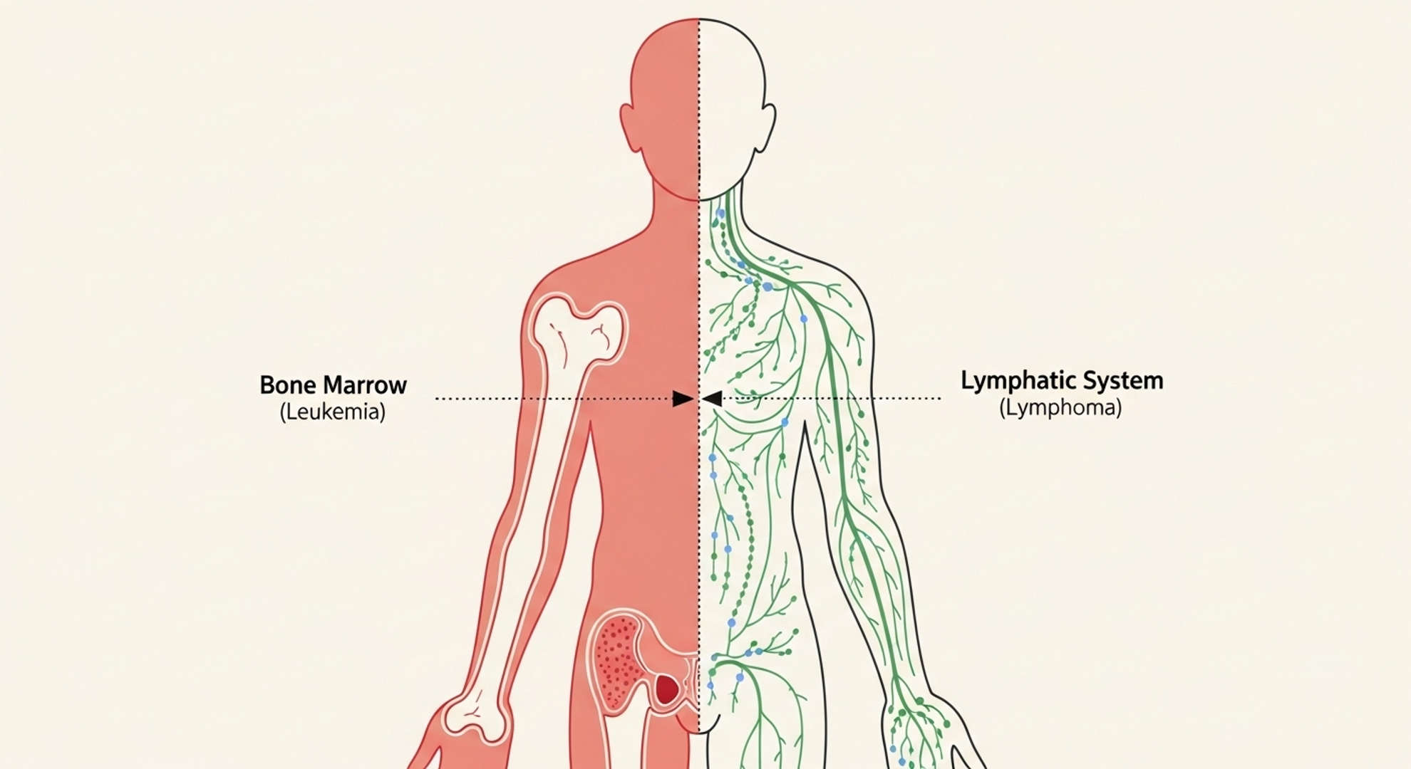 Leucémies et lymphomes, les deux grandes familles