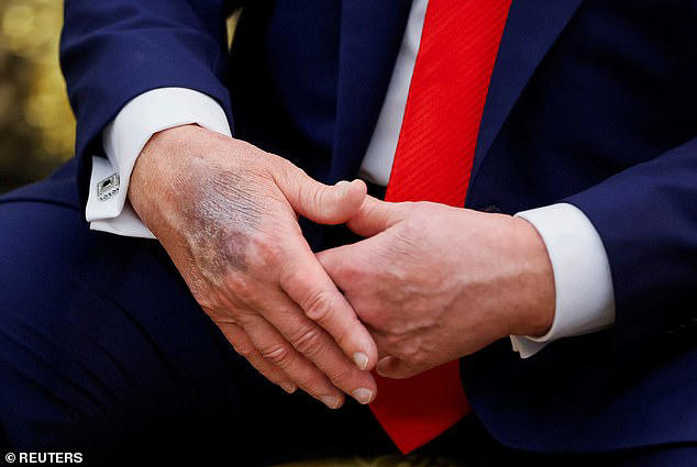 A mark on Donald Trump's hand is seen during a meeting at the White House.  Karoline Leavitt said that Trump has been diagnosed with 'chronic venous insufficiency'