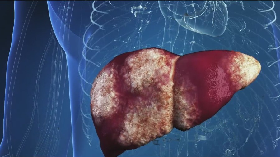 NAFLD The silent epidemic affecting 100 million Americans