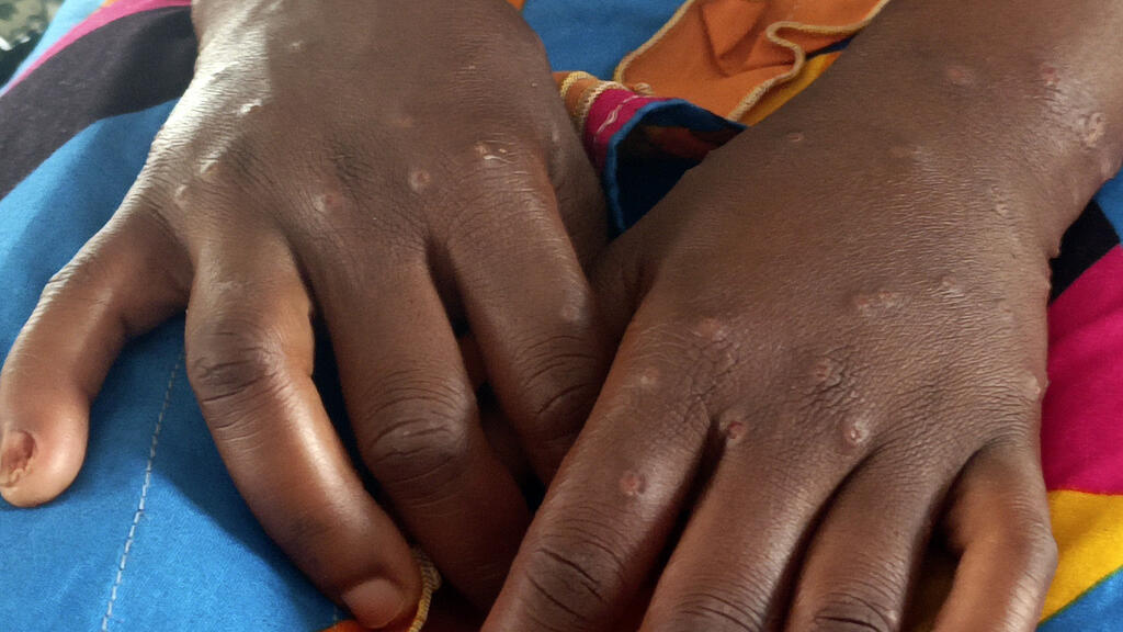 Mpox Outbreak in Guinea-Bissau: Children Make Up Half of Suspected Cases