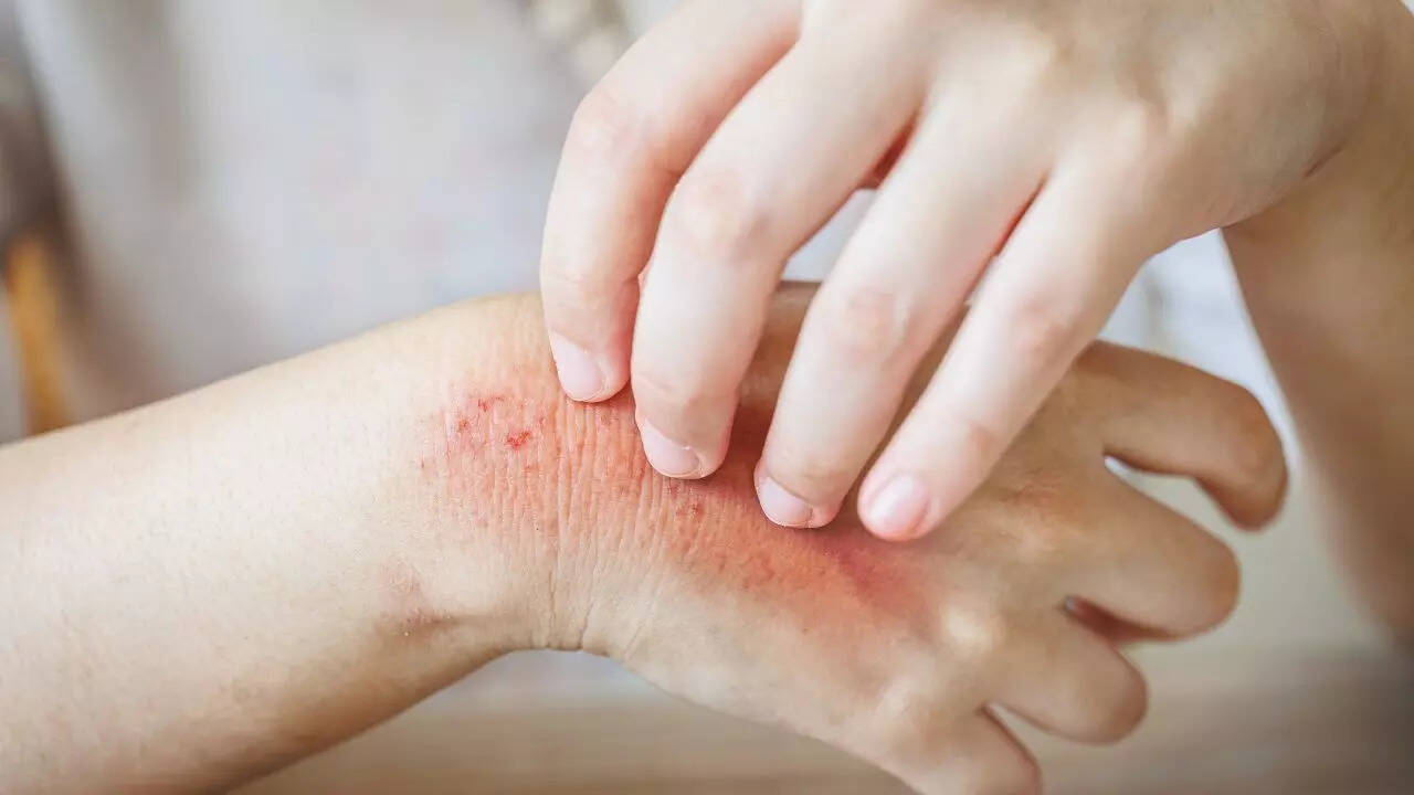 How diabetes affects the skin: 10 skin problems caused by diabetes you ...