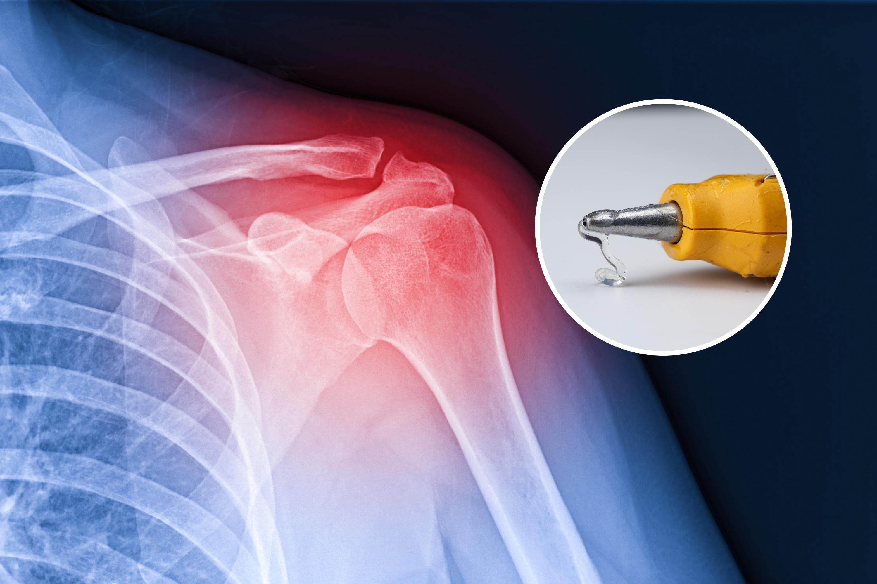 Scientists can now use glue gun to repair broken bones