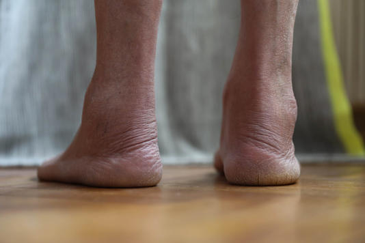 sinal-nos-pés-insuficiência-cardíaca