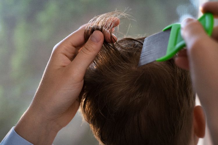 Kenali Tanda-Tanda Kutu Rambut dan Cepat Atasi dengan Solusi Aman