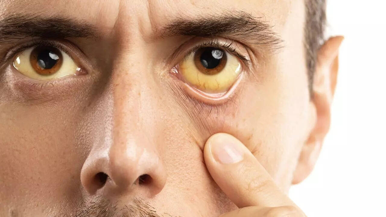 5 signs of liver disease seen on face and skin