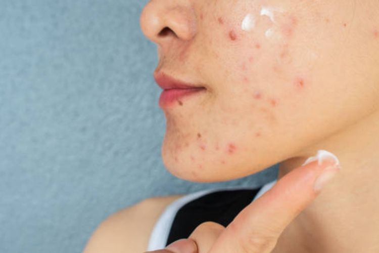 Kulit sebagai penanda stres, ini 8 tanda dari dokter