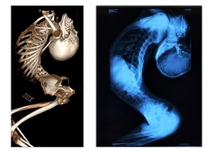 背骨が180度曲がった少年、ついに直立！「奇跡のニュース」に中国全土