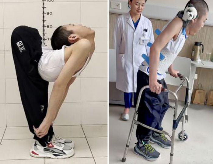 背骨が180度曲がった少年、ついに直立！「奇跡のニュース」に中国全土