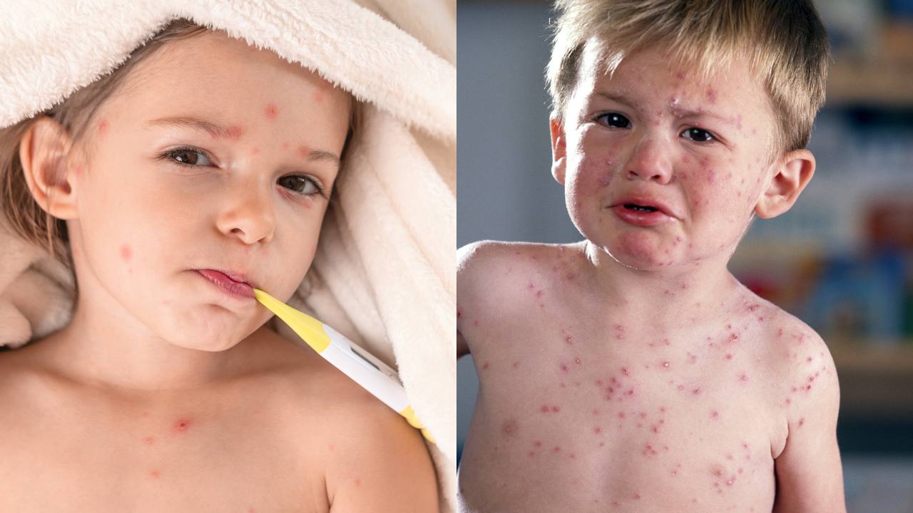 UK Children To Get Chickenpox Vaccine On NHS: Why It Is A Lifesaver Vaccine