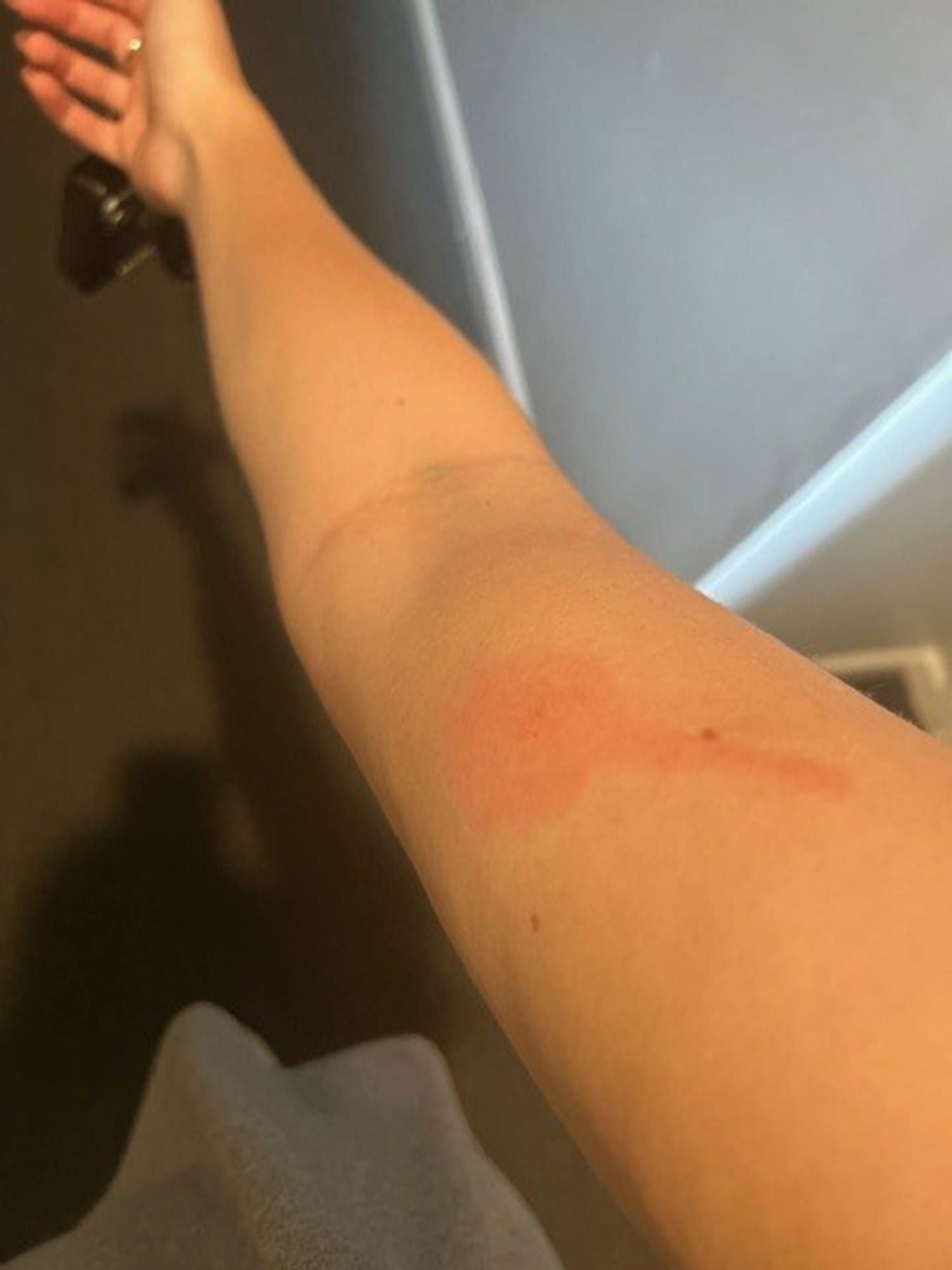 The bat bite caused a rash on Samantha Lang's arm. (Marina Kopf / NBC News)
