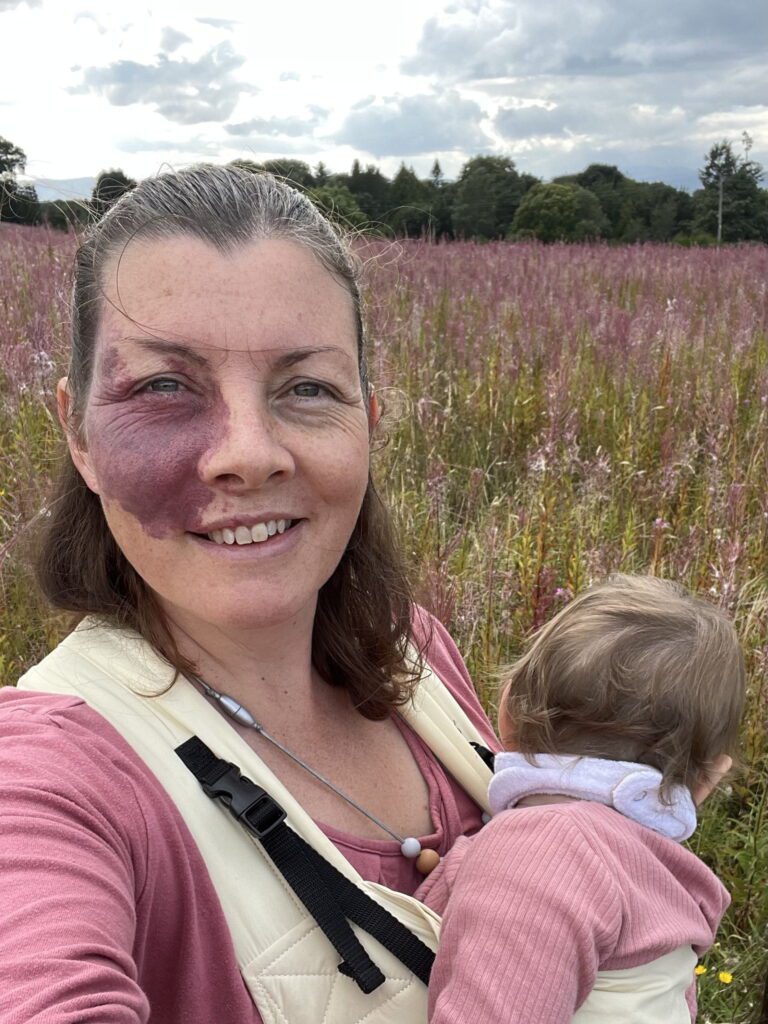 Woman covered birthmark for decades but now embraces it for her children
