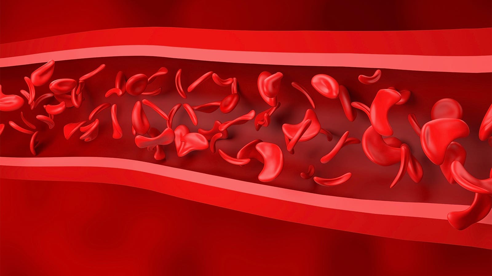 A Tale of Two Genetic Conditions: Mortality Diverges in Cystic Fibrosis ...