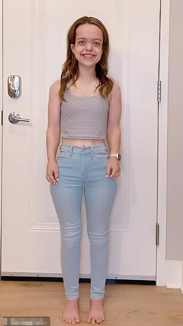 Chandler Crews hiện hài lòng với chiều cao 1,52 m nhờ kéo dài chân. Ảnh : Instagram Chandler Crews