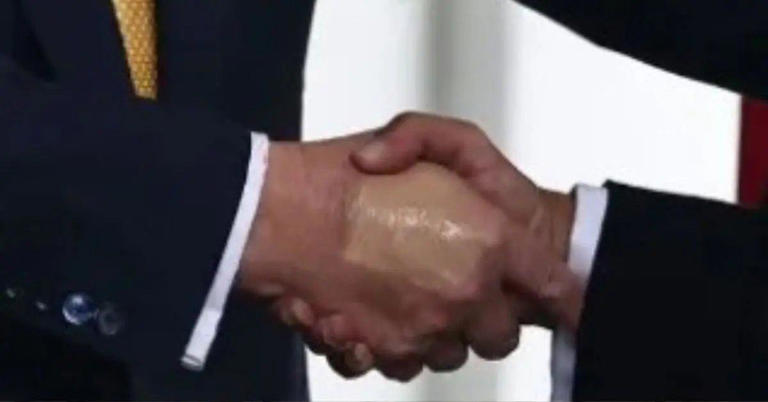 In July, it was revealed the president was diagnosed with chronic venous insufficiency.mega