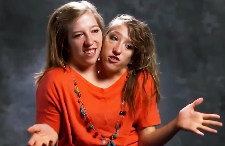 “I’m Just Confused!” One of the Famous Conjoined Twins Got Married ...