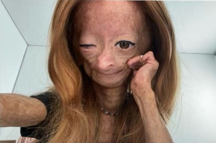 Apa Itu Penyakit Genetik Langka?