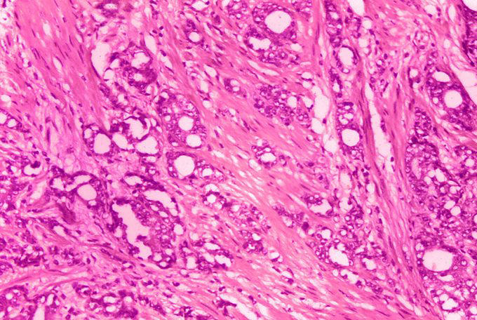 New Prostate Cancer Treatment Options You Should Know About, From a ...