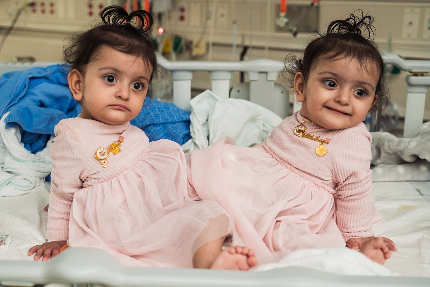 Rare Conjoined Twins Successfully Separated After 18Hour Surgery That
