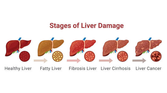 Estágios de danos ao fígado — saudável, com gordura, fibrose, cirrose e câncer/Shutterstock_ChipVector
