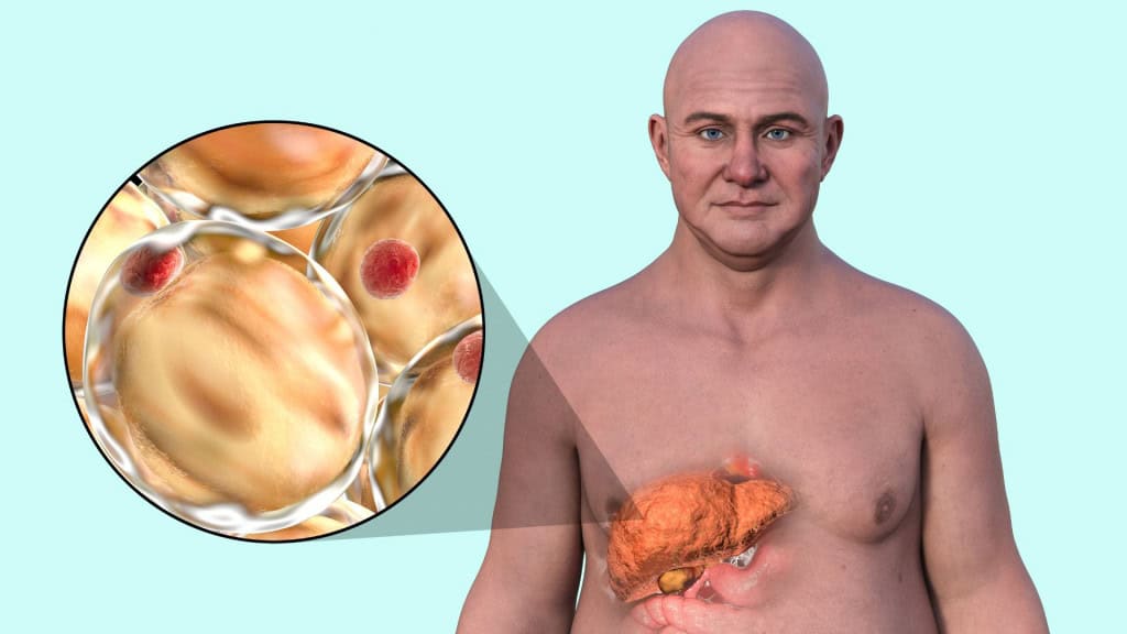 O acúmulo de gordura no fígado, quando persistente, pode desencadear inflamações que evoluem para doenças graves/Shutterstock_Kateryna Kon