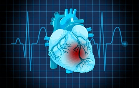 Cardiovascular surgeon distinguishes men vs women heart attack symptoms