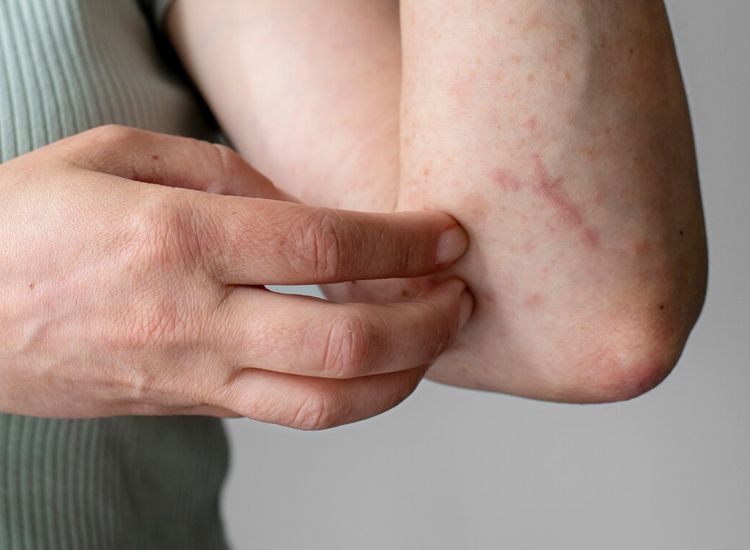 3 Jenis Daun yang Mengusir Gatal dengan Cepat