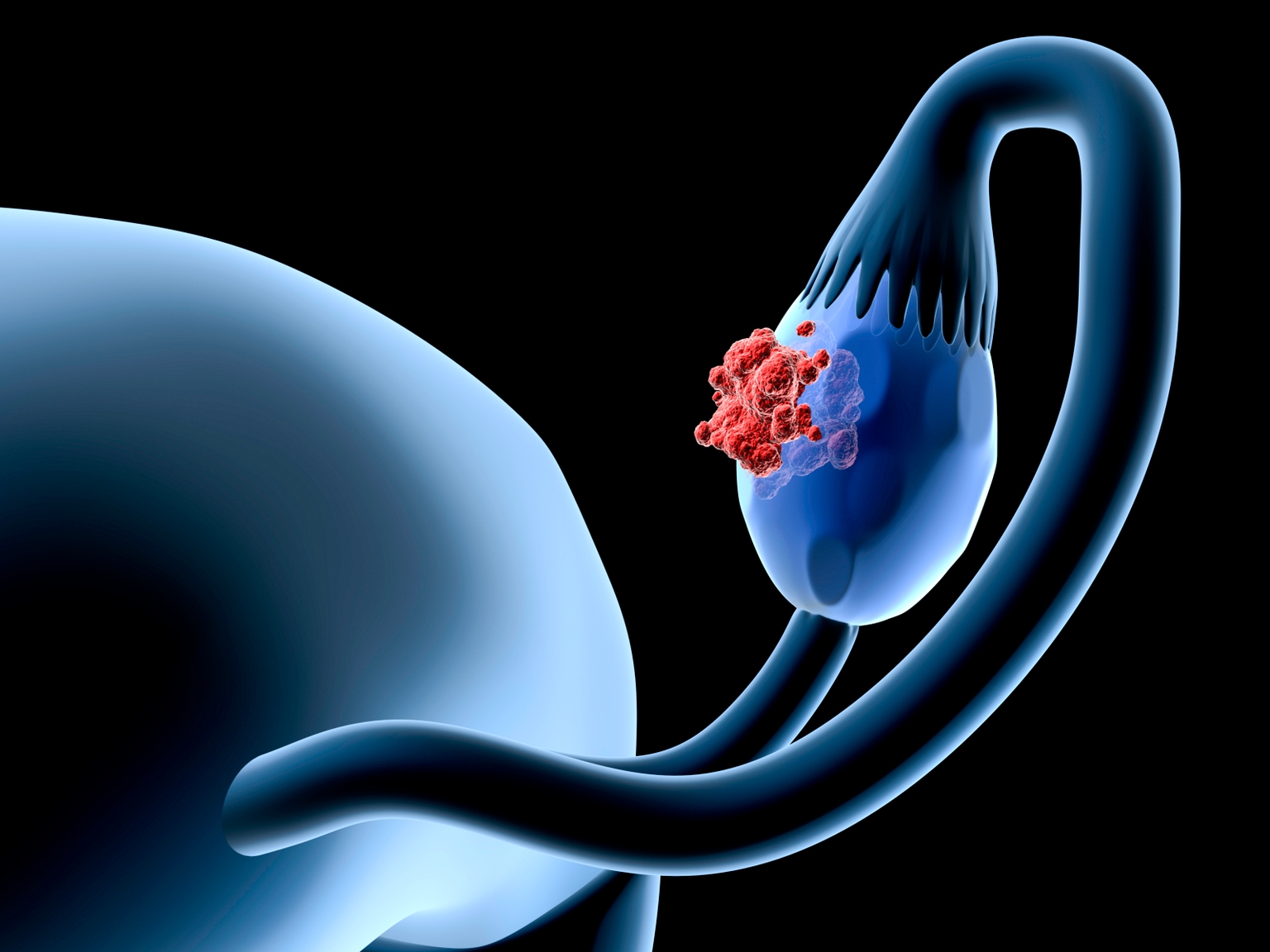 Corcept climbs as ovarian cancer therapy succeeds in late-stage trial<br><br>