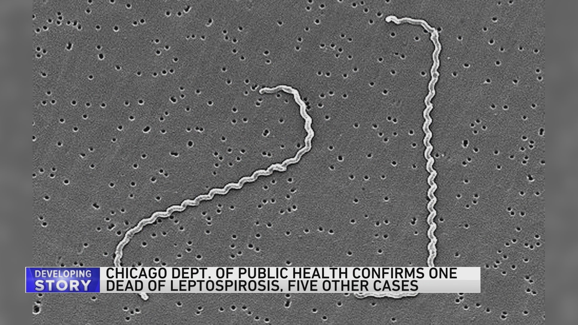 Person dies, another hospitalized for leptospirosis, Berkeley health officials say