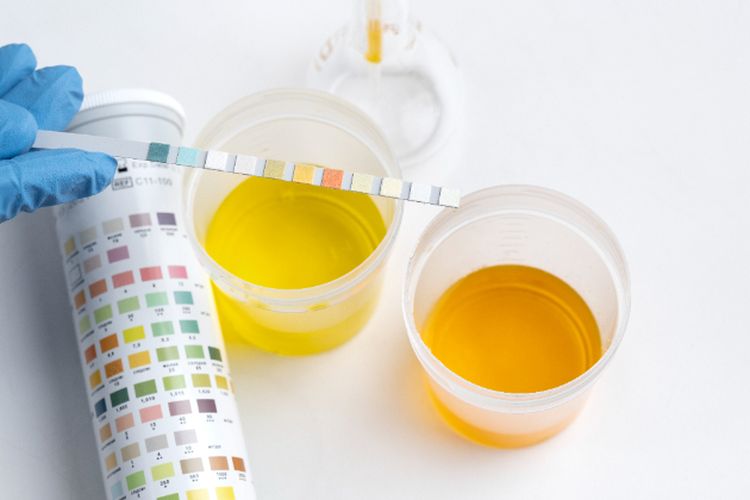 Bukan Hanya Kekurangan Cairan, Ini Fakta di Balik Perubahan Warna Urine