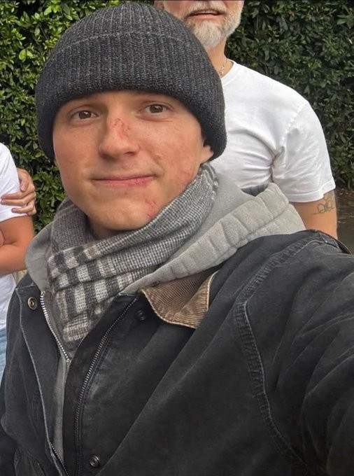 The photo went viral on X of Tom Holland's injury.