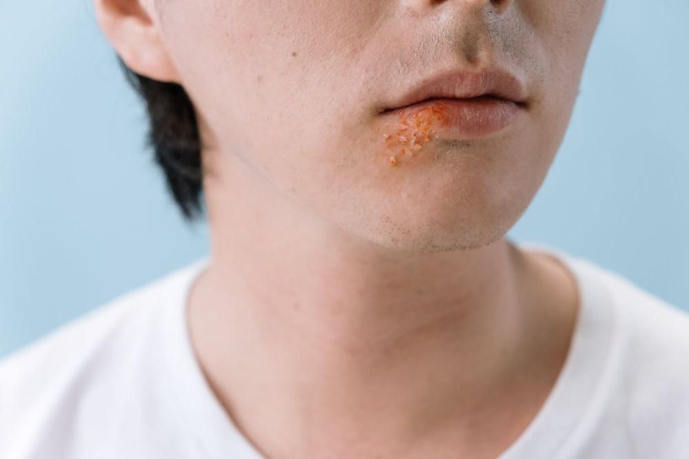 7 Cara Cegah Penyebaran Herpes, Kondom Wajib!